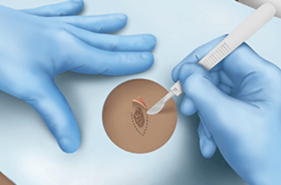 skin-biopsy-excisional.png