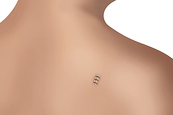 skin-biopsy-stitches.webp