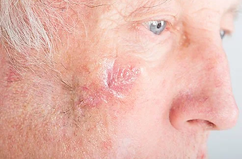 mohs healing.webp