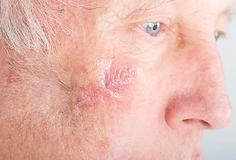 mohs healing.webp