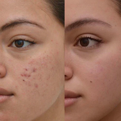 acne500x500_e5356a3c-bd9f-454d-85d2-b9d03eb1e16d_1200x.jpg.webp
