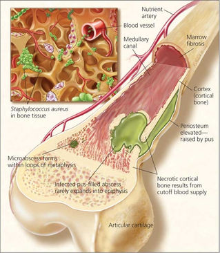 Osteomielite tem cura?