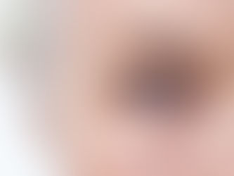 Ceratocone e o aumento de grau!