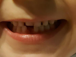 Child's grin with missing tooth