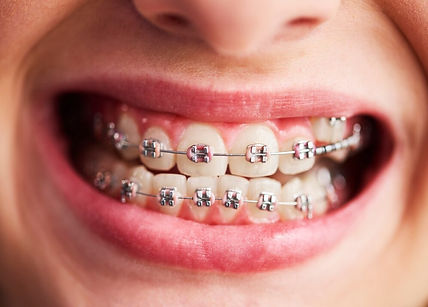 Metal & Ceramic Braces