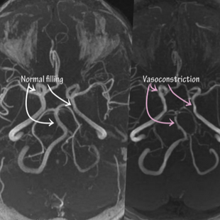 The Unseen Connection: A Neurologist and Cardiologist Unlock a Women's Health Mystery