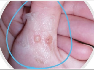 In Vitro and Randomized Controlled Clinical Study of Natural Constituents' Anti-HPV Potential for Treatment of Plantar Warts Supported with In Silico Studies and Network Analysis