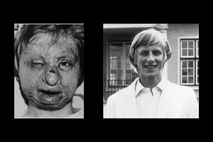 The picture shown on the left is a victim photographed shortly after a burn accident. The person is a male. The left eye is slightly ajar. Surrounding the left eye are dark patches. The left eye brow can hardly be seen. The male is not smiling but is lip is dark and covered with discoloration. The right eye is open fully. His hair appears to be soaked in dried blood. On the right, is the same man before the accident. He is wearing a white colored jacket and white shirt underneath. He has shirt, blonde hair that cover his ears.