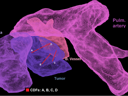 Dosie™ validated in I-PDT clinical trial to treat Malignant Central Airway Obstruction