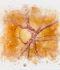 glaucoma eye