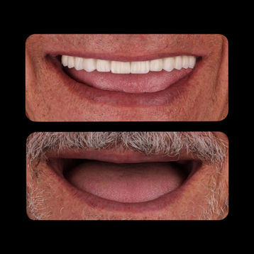 Fotografie înainte și după a unui pacient de sex masculin care prezintă restaurarea completă a zâmbetului, inclusiv înlocuirea dinților lipsă și decolorați.