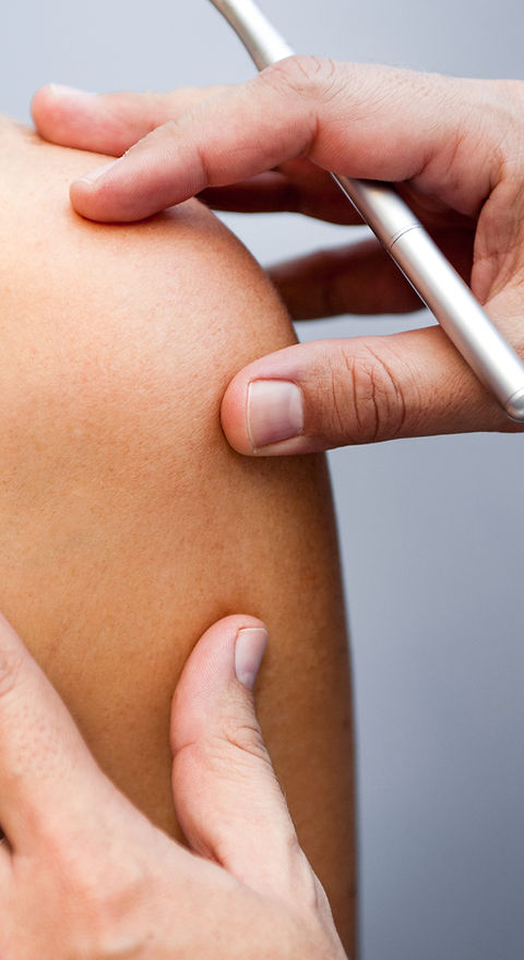 Birthmark