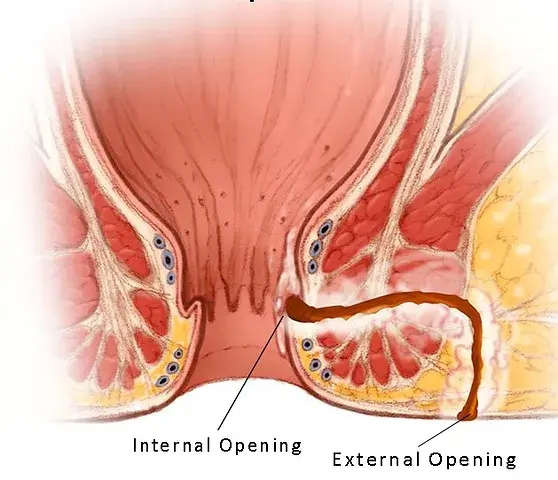 Abses Perianal & Fistula Ani