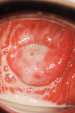 膣トリコモナス症の画像・写真：おりもの（帯下）③