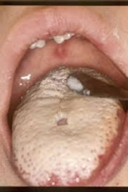 口腔カンジダ症・舌への発症の画像写真