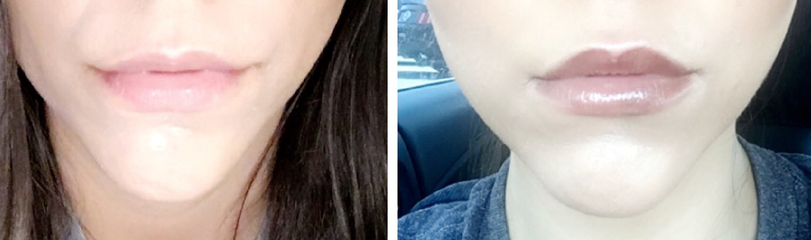 2 Juvederm Ultra +