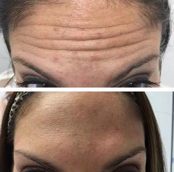 Botox $8.5/u (members)