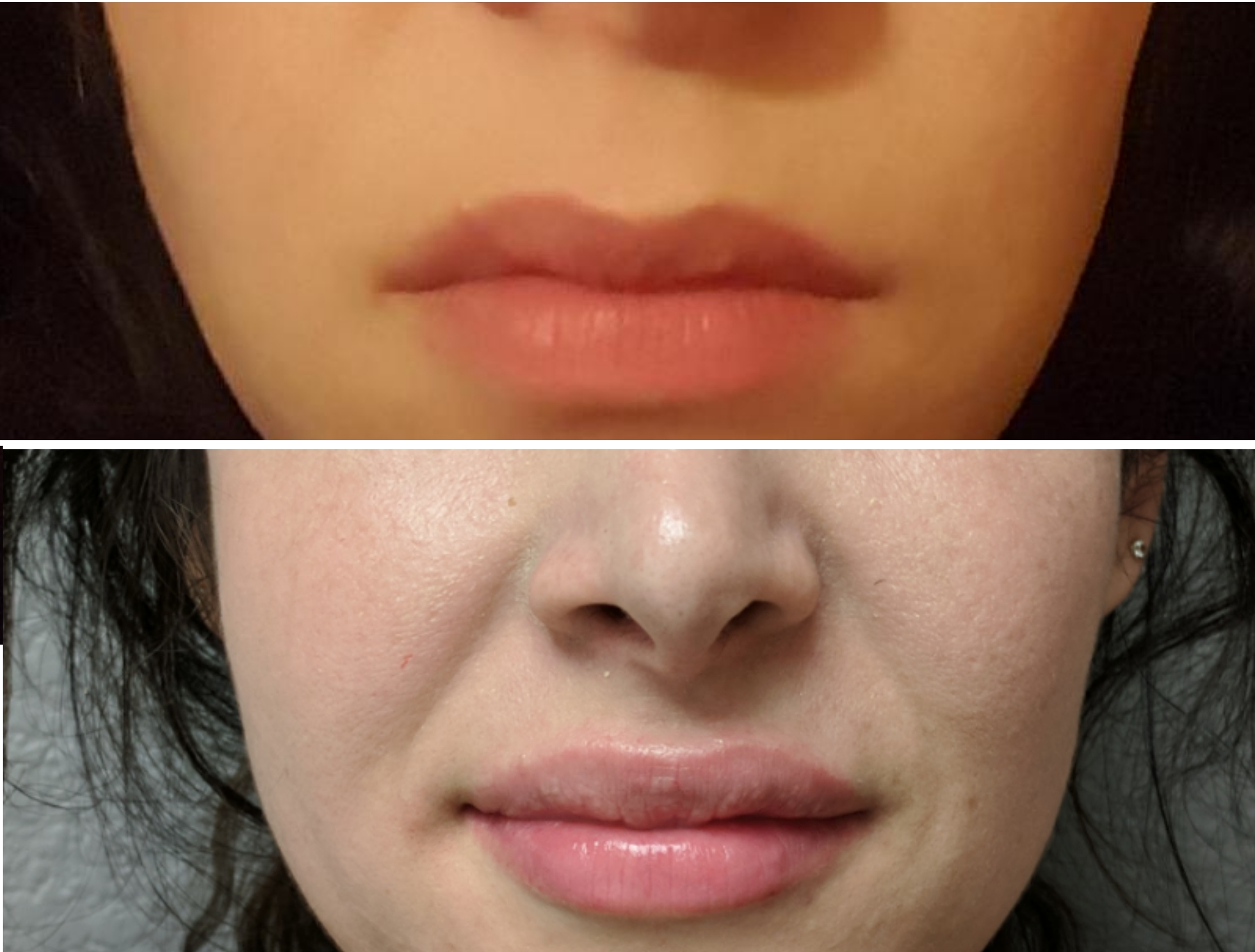 juvederm before and after 1 syringe