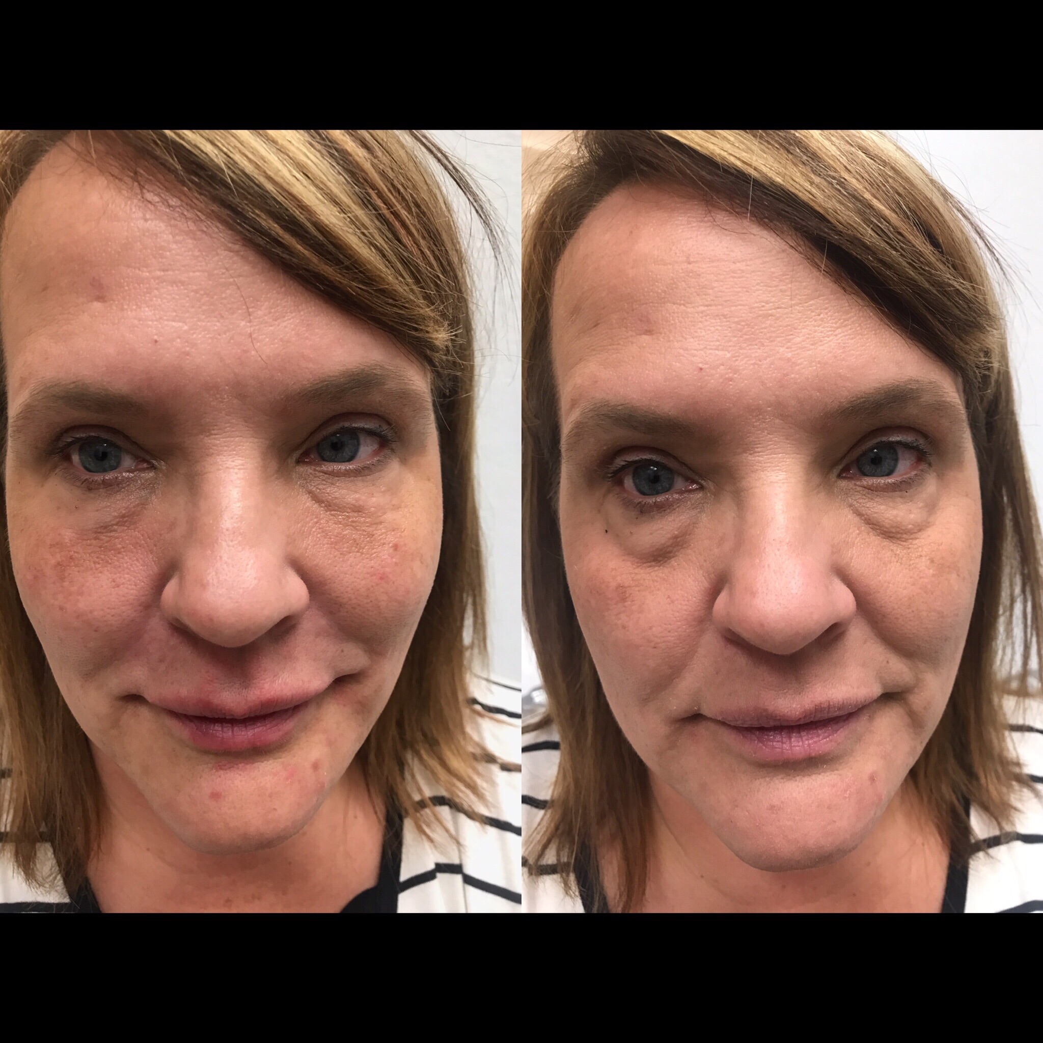 before and after tear trough filler-