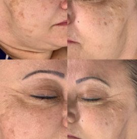 After 1 BBGLOW Treatment