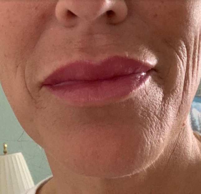 Juvederm Lips after 1 syringe