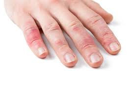 PSORIASI, 3 MILIONI DI MALATI IN ITALIA, 84% DELUSI DALLE CURE
