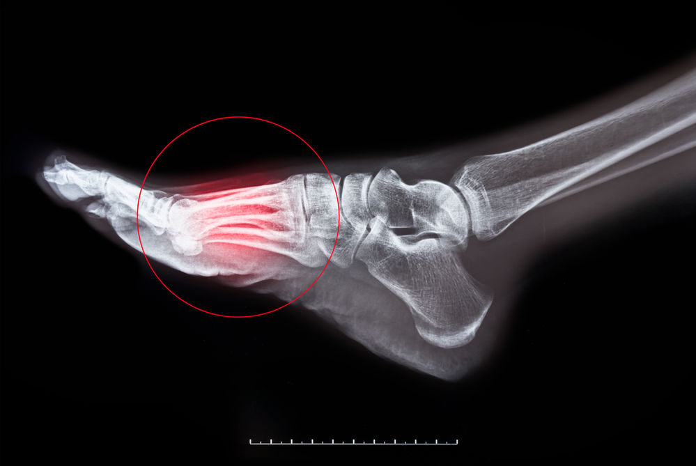 Is Your Foot Fracture an Early Sign of Osteoporosis?