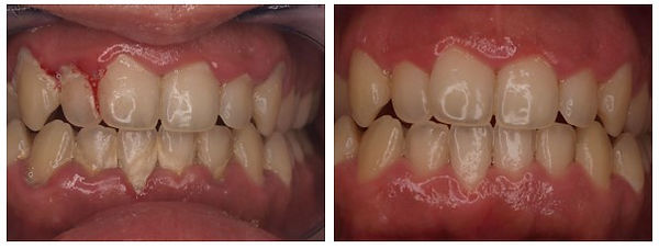 Periodoncia Caso 1