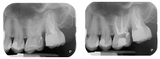 Radiografia Caso 1