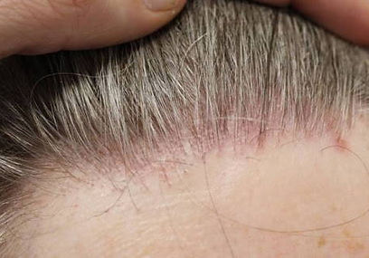 דלקת בקרקפת