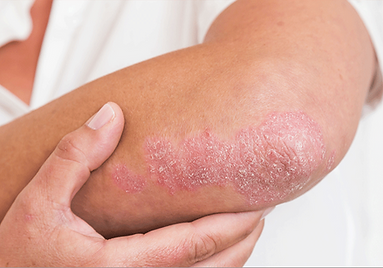 בעיות עור - פסוריאזיס