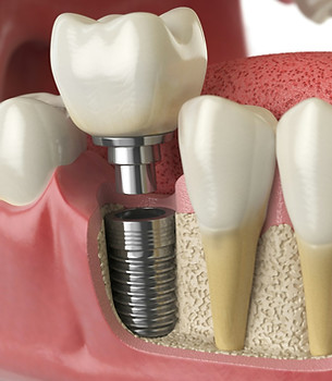 anatomy-of-healthy-teeth-and-tooth-dental-implant-in-human-dentu.jpg