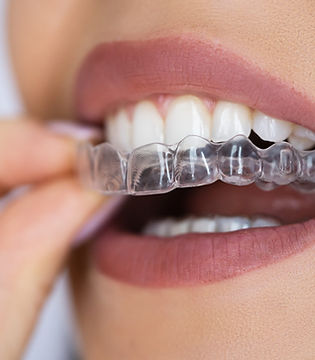 bigstock-Clear-Aligner-Dental-Night-Gua-463488851.jpg