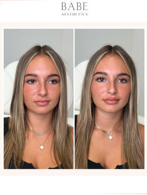 Most reliable lip filler Long Island