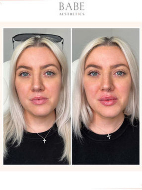 First time lip filler near me