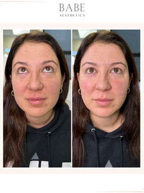 Lip filler before and after Rockville Centre