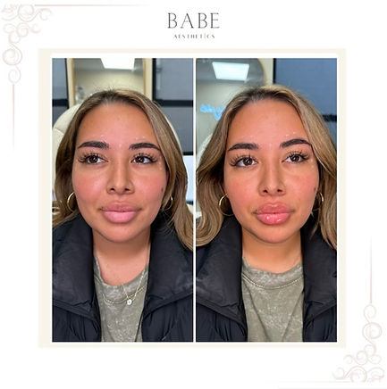 Lip Filler Long Island