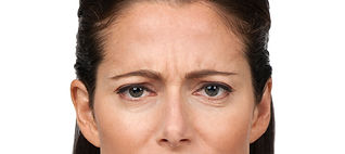 1 Botox Before.jpeg