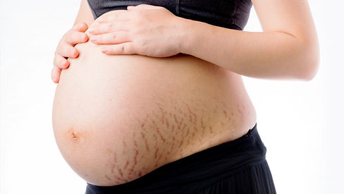 stretch-marks-1280x720.jpeg