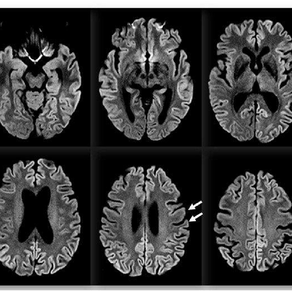The Mystery disease - The discovery of  Creutzfeldt-Jakob Disease