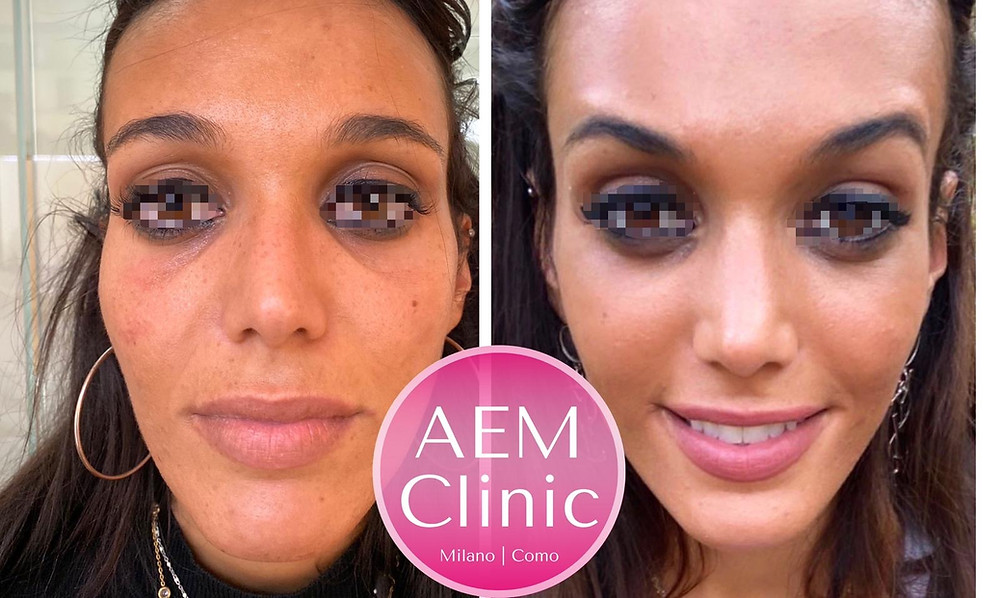 filler occhiaie milano como