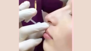 Corso di Rinofiller per Medici e Odontoiatri: Perfeziona la Tecnica con l'esperienza del Dr Zattoni