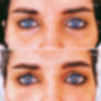 filler occhiaie dr zattoni milano como