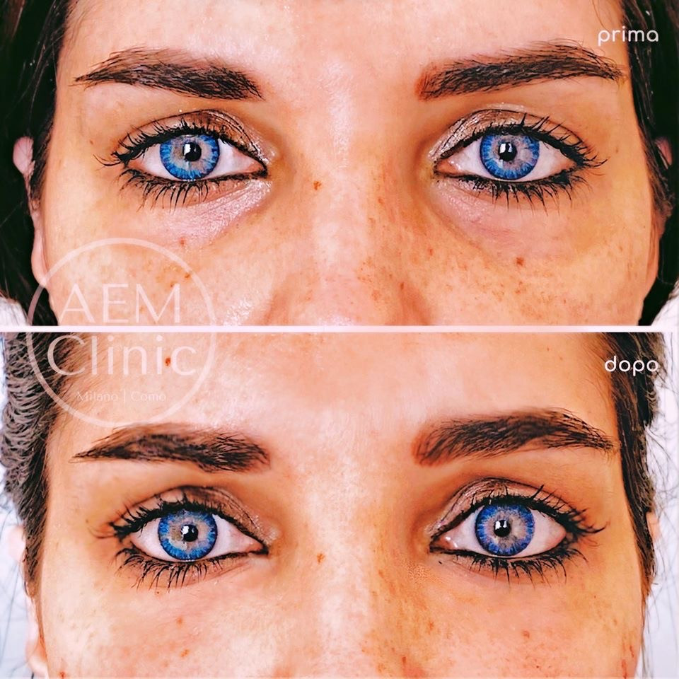 filler occhiaie dr zattoni milano como