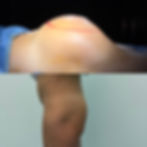 gluteoplastica sottomuscolare protesi glutei milano como dr luca zattoni