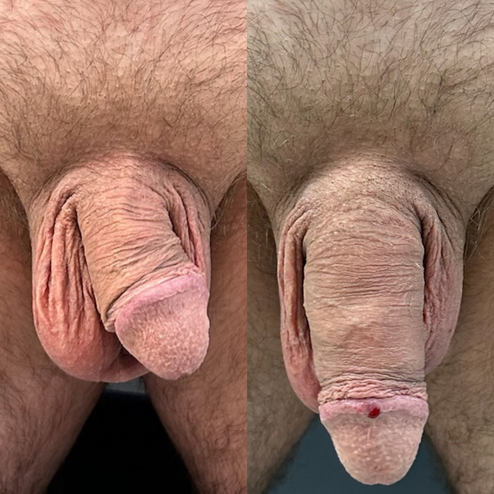 filler pene milano dr Luca Zattoni ingrossamento allungamento como falloplastica non chirurgica