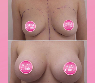 breast augmentation