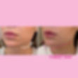endolift dr zattoni milano como