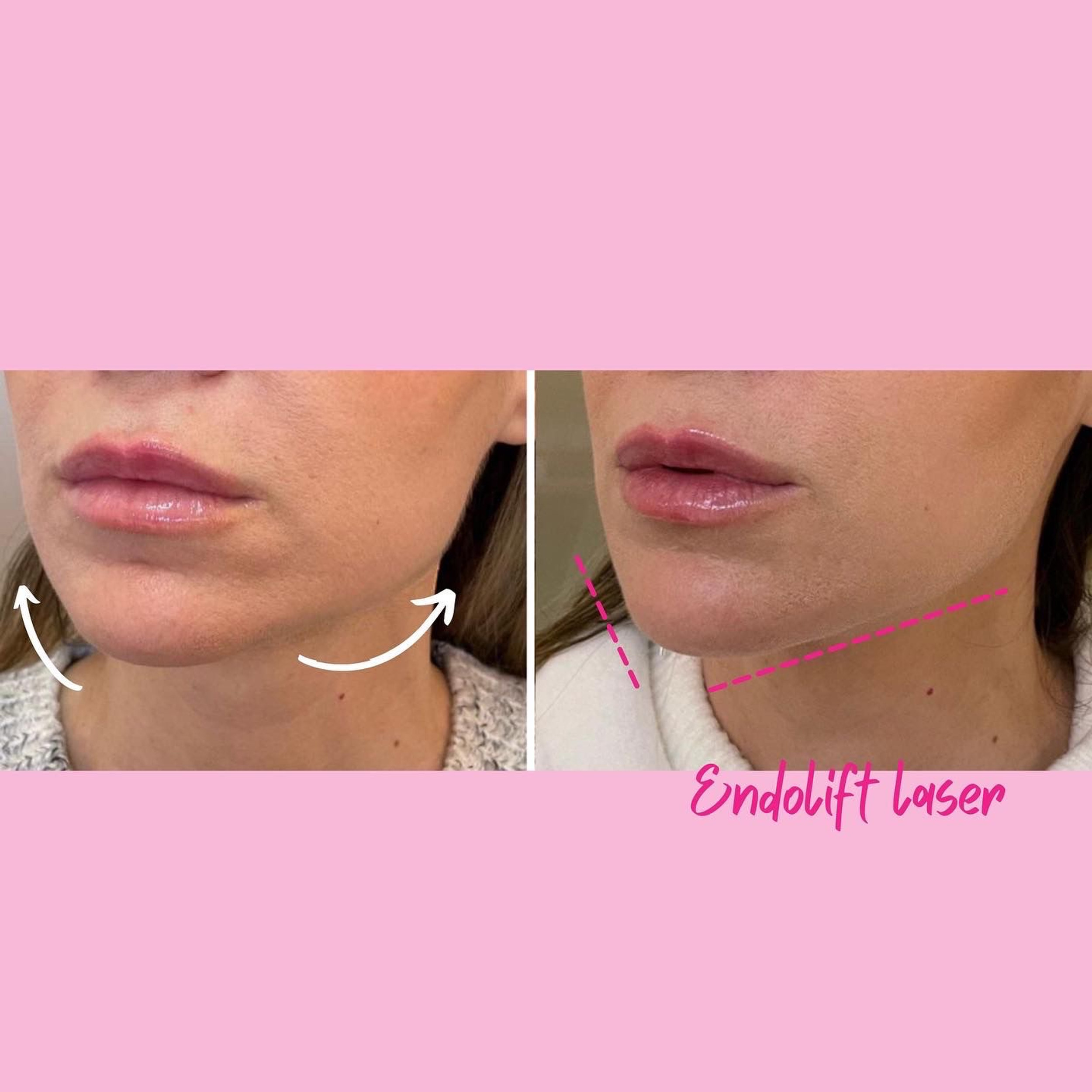 Lifting Corpo e Viso Endolift Eufoton - Milano - Como Aesthetic