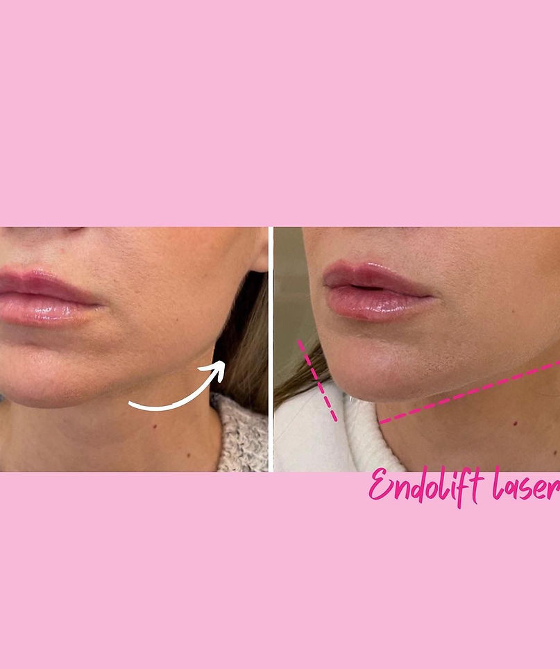 endolift dr zattoni milano como